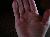 dupuytren 004_resized.jpg