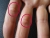 Dupuytren rechte Hand.jpg