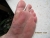 110920fussblase_zu.jpg