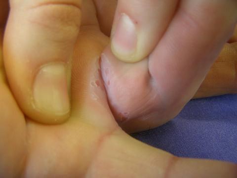 Entzündete Haut bei stark gekrümmtem Finger (Dupuytren im fortgeschrittenen Stadium)