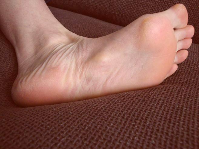 Fuß mit Ledderhose, etwa 2 Monate nach Bestrahlung. Die Knoten sind deutlich kleiner geworden.