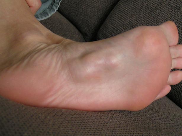 Fuß mit Ledderhose-Knoten vor Bestrahlung