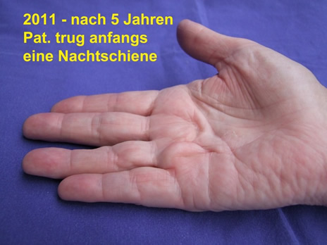 Die Hand 6 Jahre nach der Nadelfasziotomie. Die Finger sind gerade. Der Patient trug zeitweise eine statische Nachtschine.