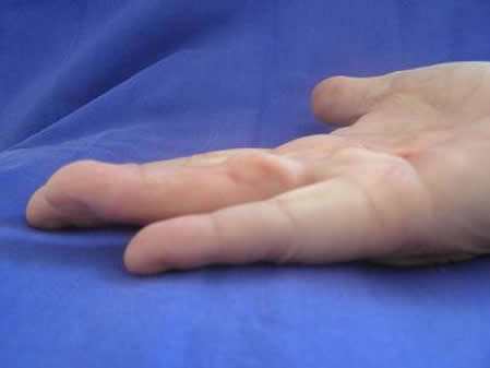 Unmittelbar nach der Nadelfasziotomie, fest gestreckter Finger