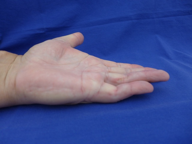 Ergebnis nach 2,5 Monaten und regelmäßigem Tragen eine Nachtschiene. Beide Finger sind deutlich besser als unmittelbar nach der PNF.