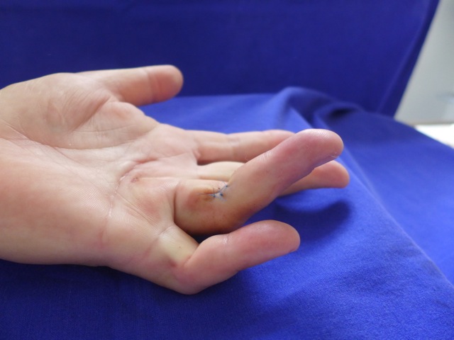 Zustand der hand unmittelbar nach der Nadelfasziotomie. Der Ringfinger konnte deutlich, der kleine Finger etwas geöffnet werden.