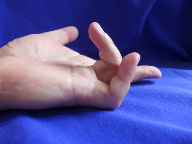 Hand prior to NA. Small and ringer finger are affected, in Tubiana stage 3.