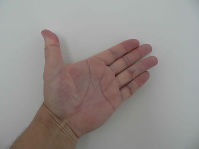 Nach 2,5 Jahren sind die Finger immer noch gerade. Der Patient trug während der gesamten Zeit eine Nachtschiene.