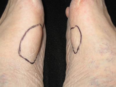 Ledderhose-Krankheit mit starker Knotenbildung in der Fußsohle
