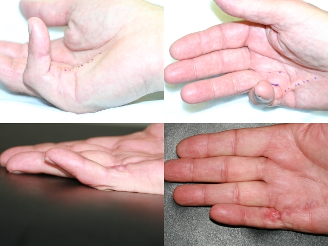 Nadelfasziotomie der Dupuytren'schen Kontraktur im Stadium 4. Auch stark gekrümmte Finger können geöffnet werden.