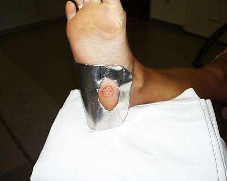 Abschirmen der des nicht zu bestrahlenden Teils des Fußes mit Blei. Ledderhose-Behandlung mit Röntgenstrahlen.